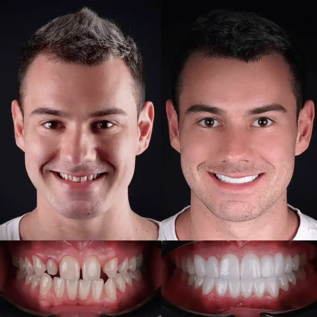 emax-before-after-19