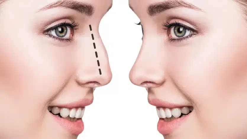 https://sayginhealth.com/wp-content/uploads/2025/06/rinoplasti.webp